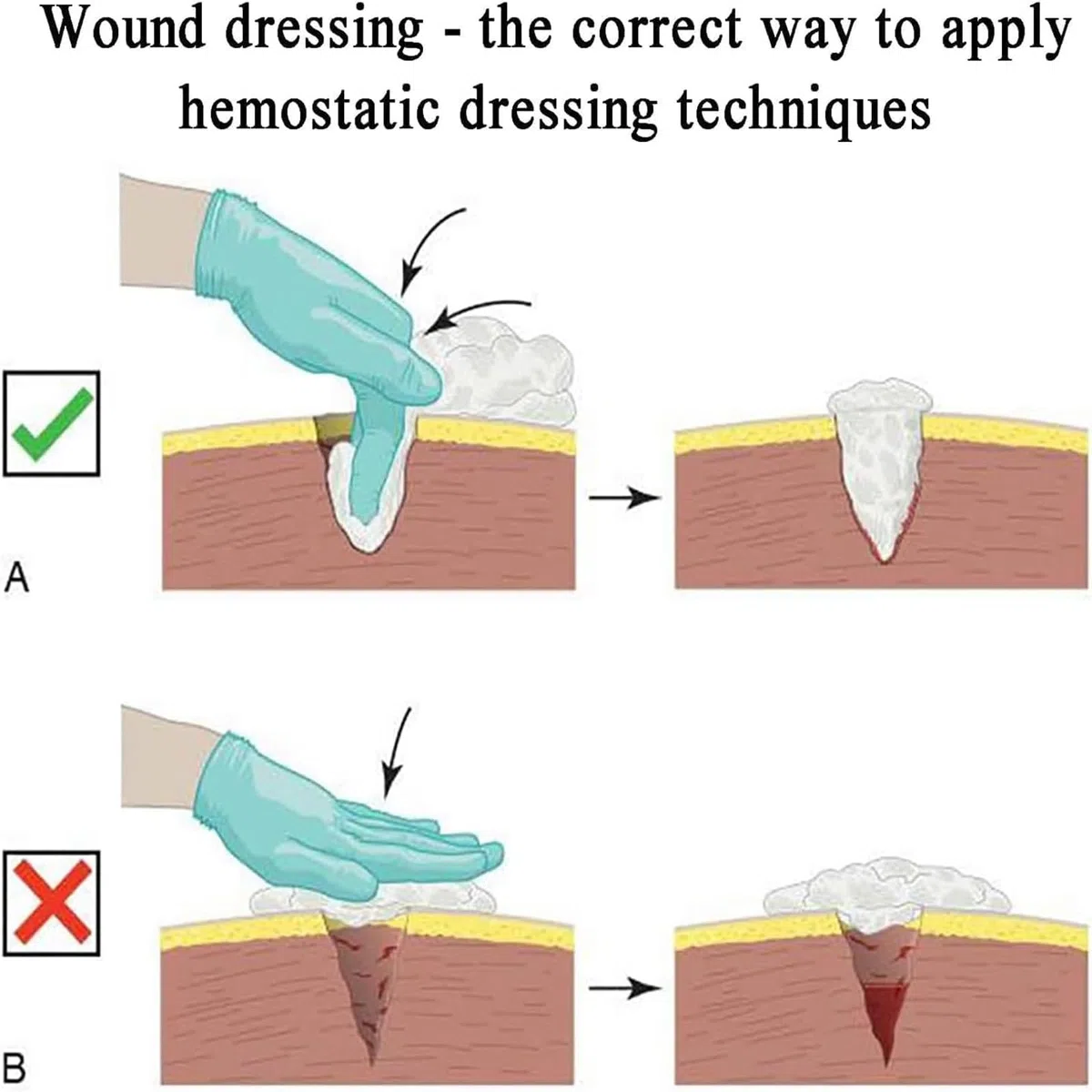 Wound Packing Trainer, Stop The Bleed Training Kit, Deep Laceration Trauma Module, Haemostasis Practice Model, Blood Control Exercises, Suturing Exercises, for Course, Military & First Aid Training